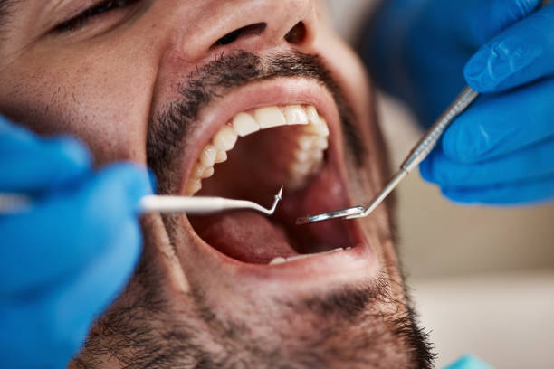 Best Emergency Wisdom Teeth Removal in Grove City, OH
