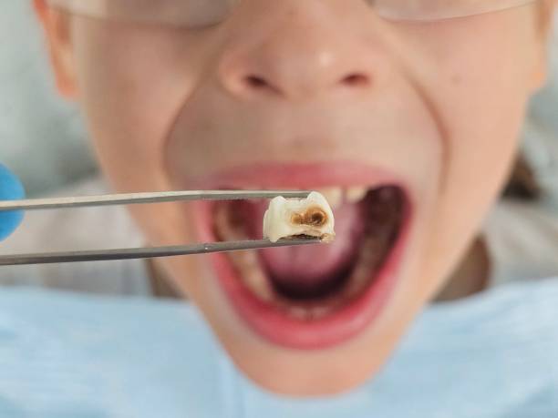 Best Pediatric Emergency Dentist in Grove City, OH